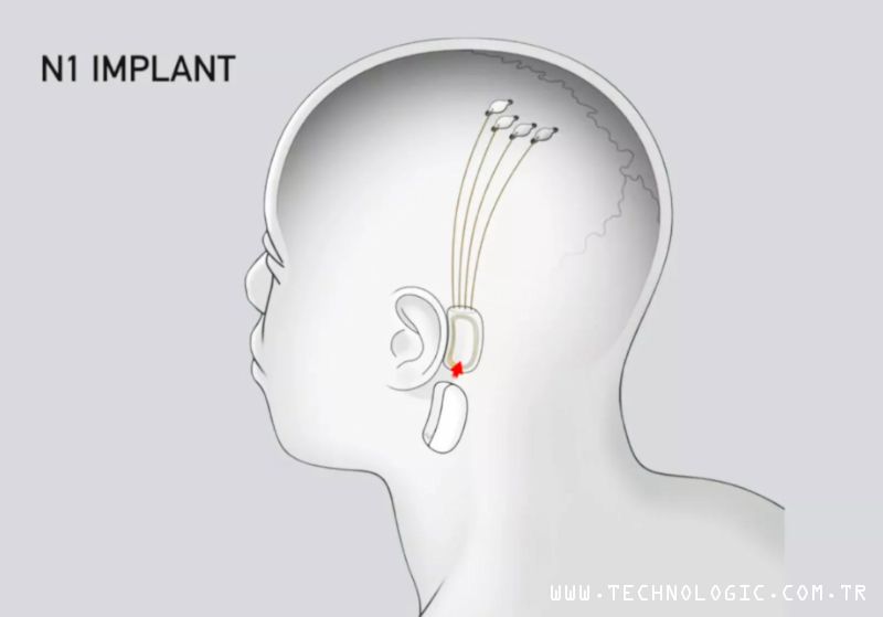 Elon Musk Neuralink_n1_implant